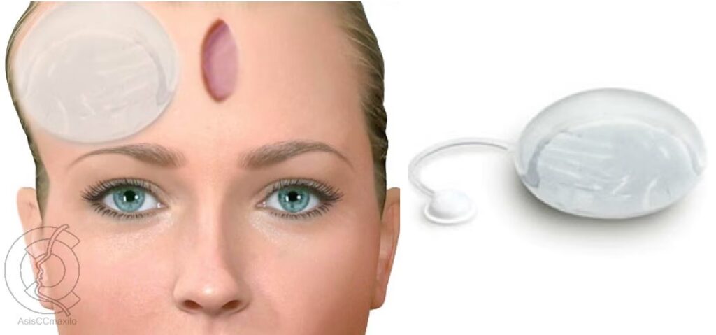 Expansores de Piel: ¿Dolor, Riesgos y Beneficios?