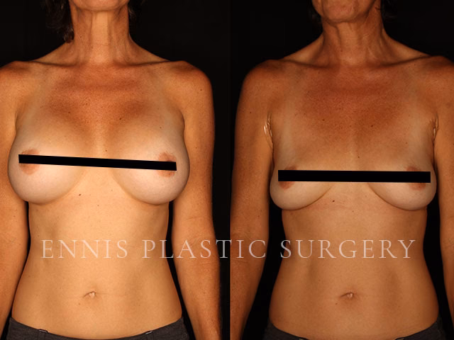 ¿Qué puede salir mal en una cirugía de senos?