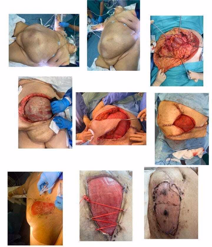 ¿Qué tipo de cirugía se realiza para la fascitis necrosante?