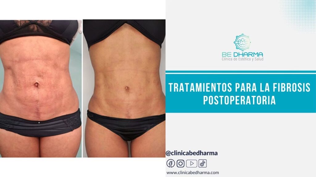 Fibrosis en la Piel: ¿Qué es y Cómo se Trata?