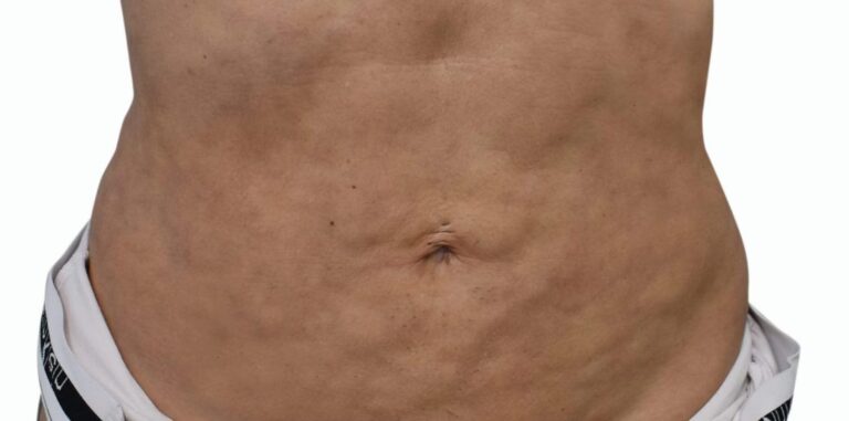 Fibrosis Postquirúrgica: Qué es y Cómo Tratarla