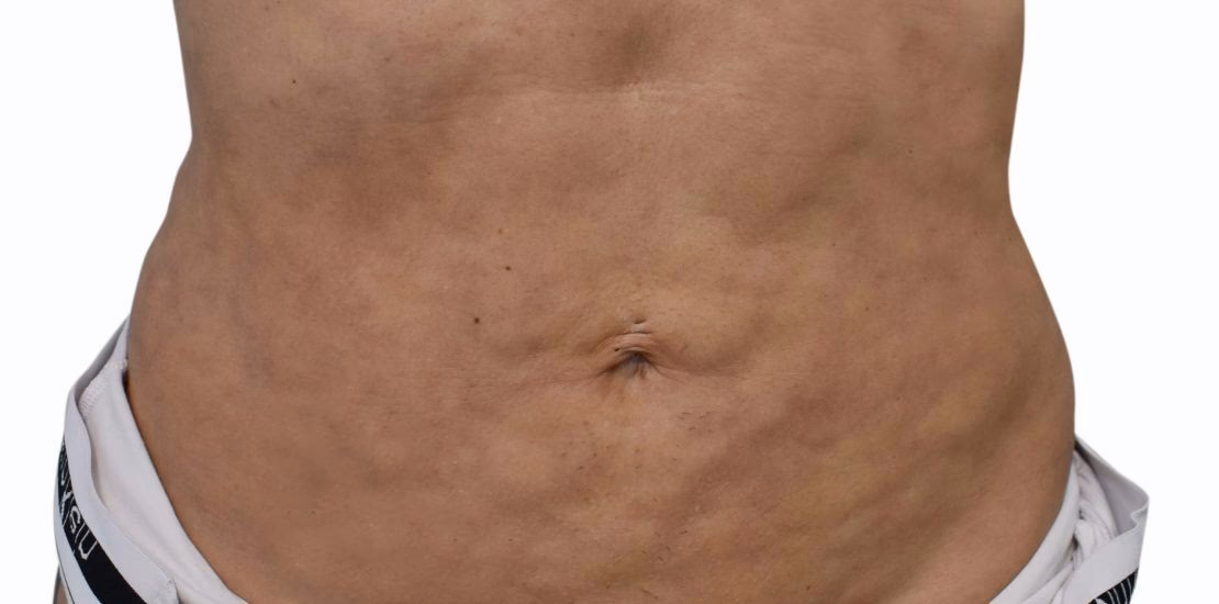 ¿Puede la fibrosis causar edema?