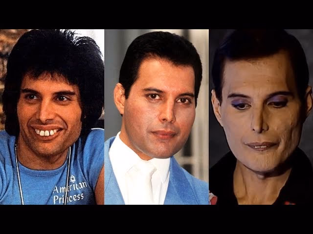 ¿Se operó Freddie Mercury?