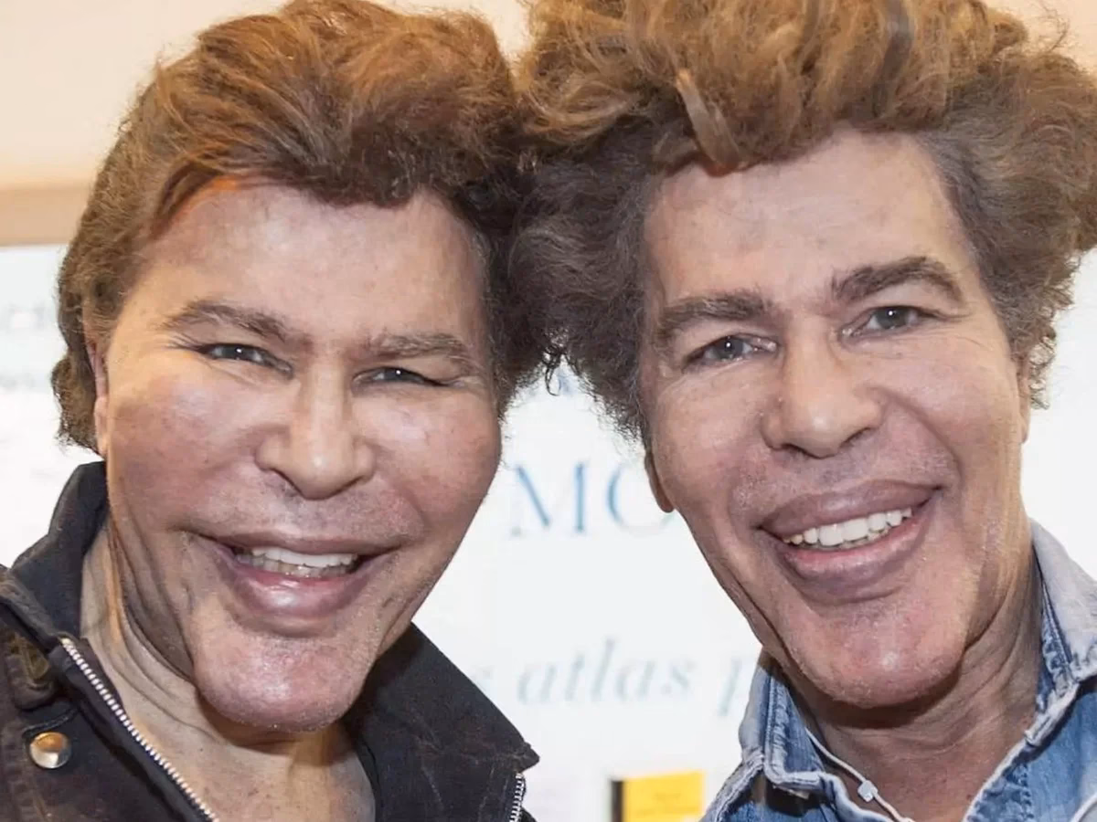 ¿Qué es la cirugía de gemelos?