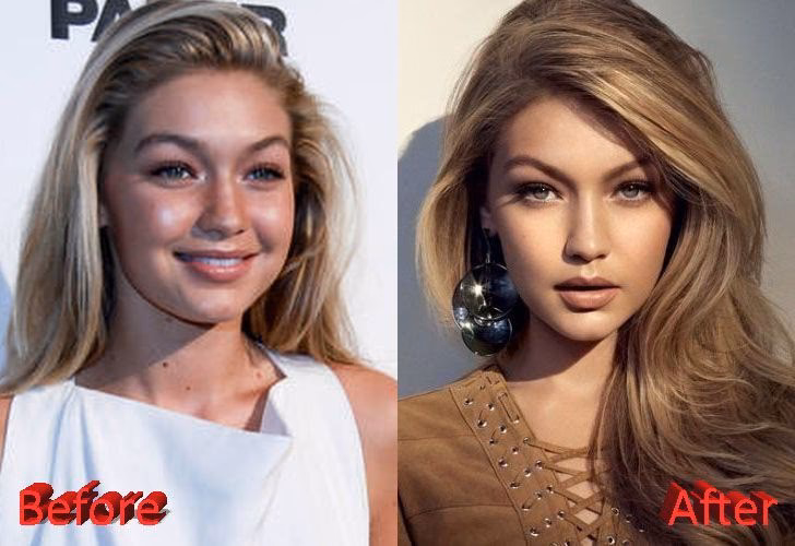 ¿Qué cirugías se ha realizado Gigi Hadid?