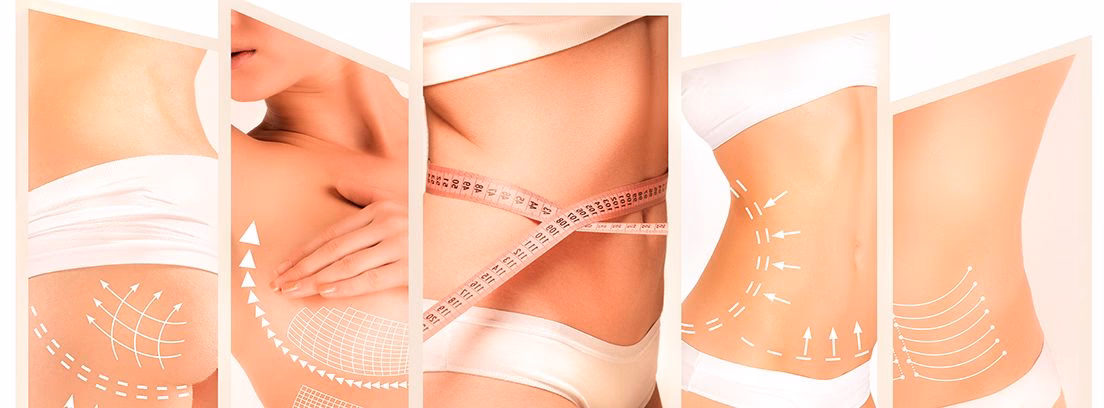 ¿Cuánto tiempo después de una cirugía puedo barrer y trapear?