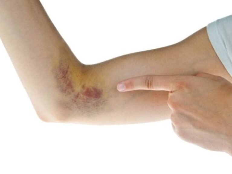 Moretones Tras Cirugía: ¿Cuándo Preocuparse?