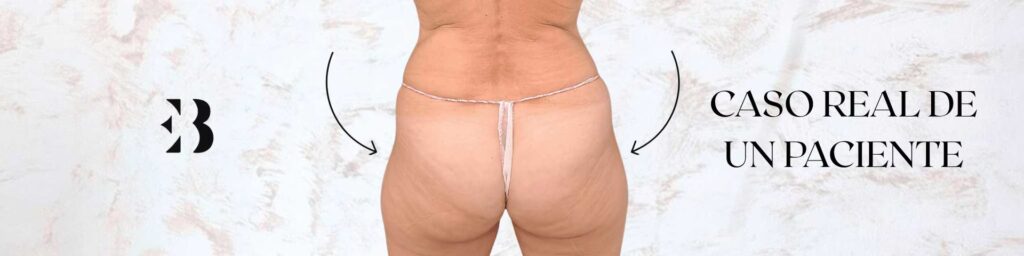 Corrección de Hip Dips: Precios y Soluciones