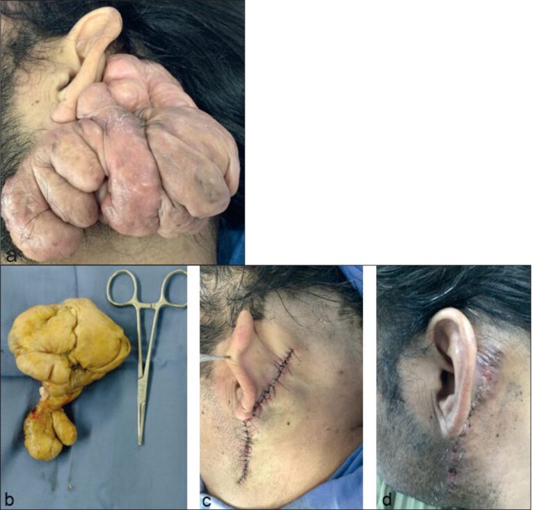 Extirpación de Queloides: Precios y Opciones