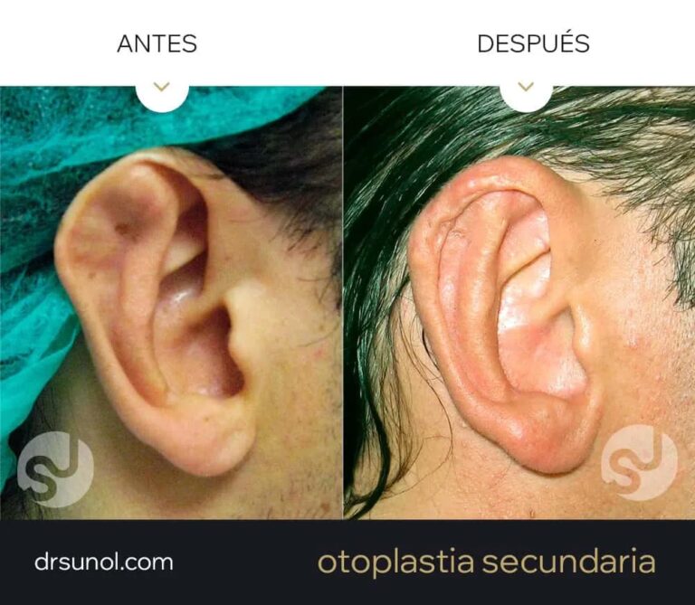Otoplastia: Guía del Postoperatorio y Recuperación