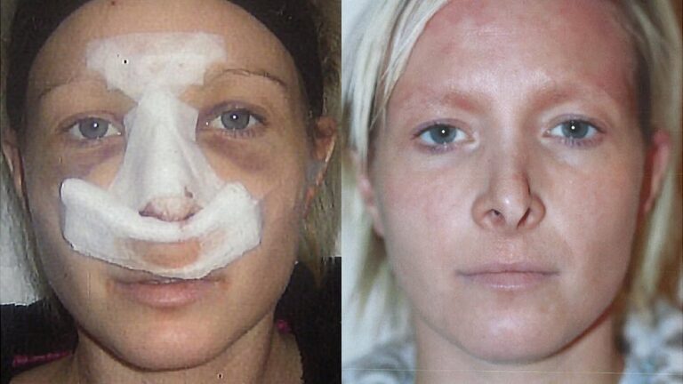 Peligros y Desventajas de la Cirugía Plástica