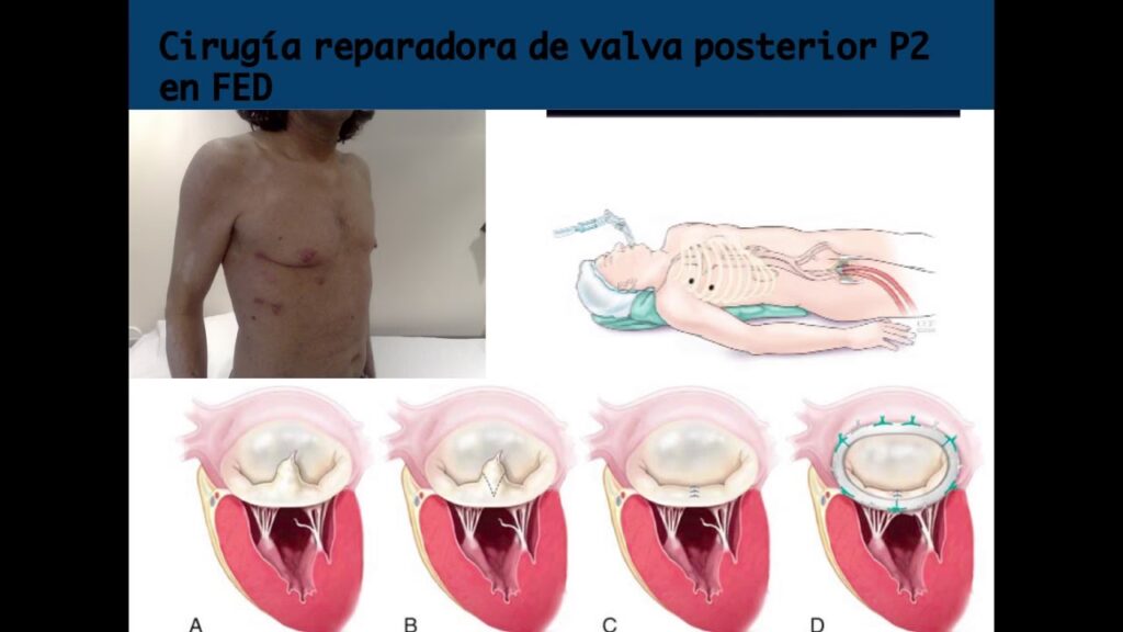 Cirugía de Válvula Mitral: Guía Completa