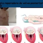 Cirugía Plástica con Insuficiencia Cardíaca