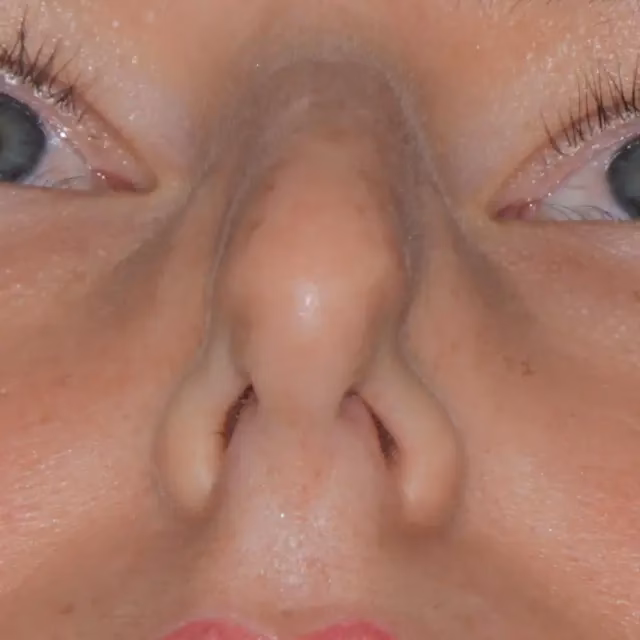 ¿Pueden someterse a cirugía plástica las personas con insuficiencia cardíaca?