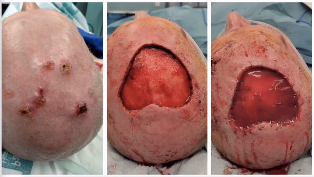 ¿Qué es la membrana Integra?