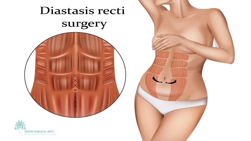 Diástasis Abdominal y la Seguridad Social: Cobertura