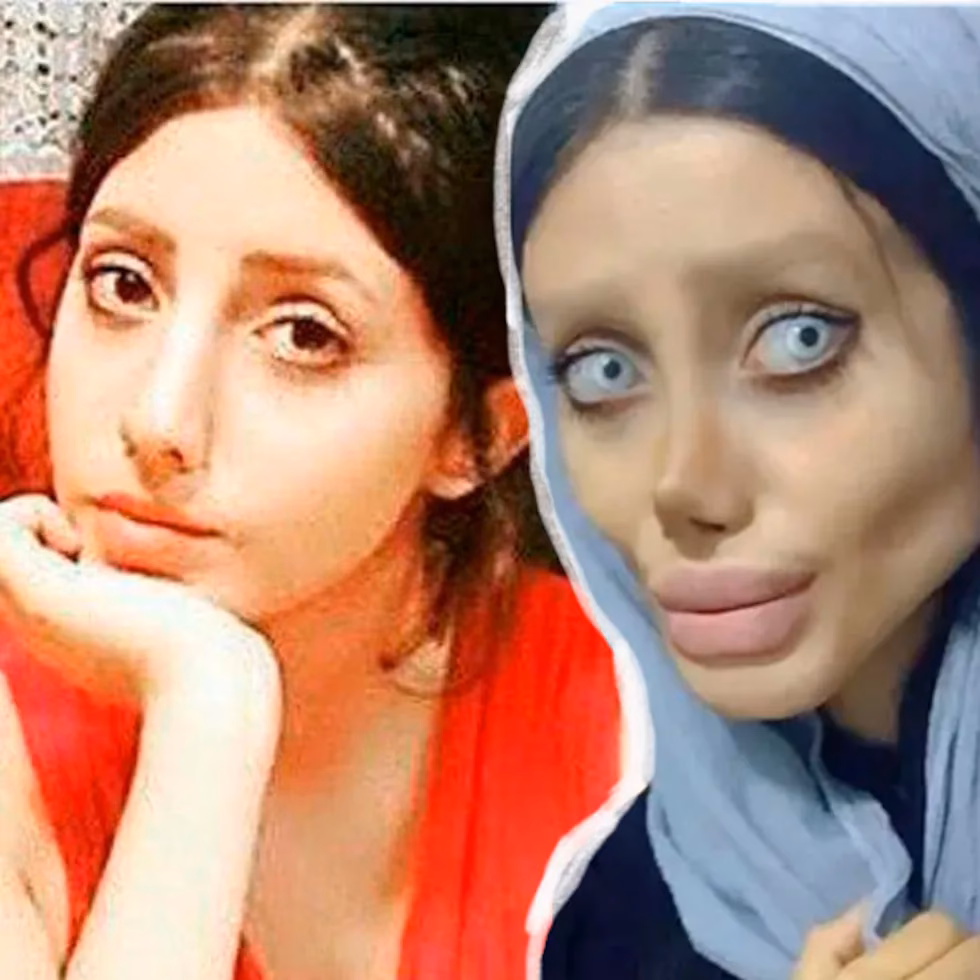 ¿Por qué a los iraníes les encanta la cirugía plástica?