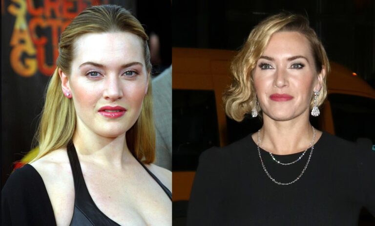 Kate Middleton: ¿Cirugía Real o Rumor Real?