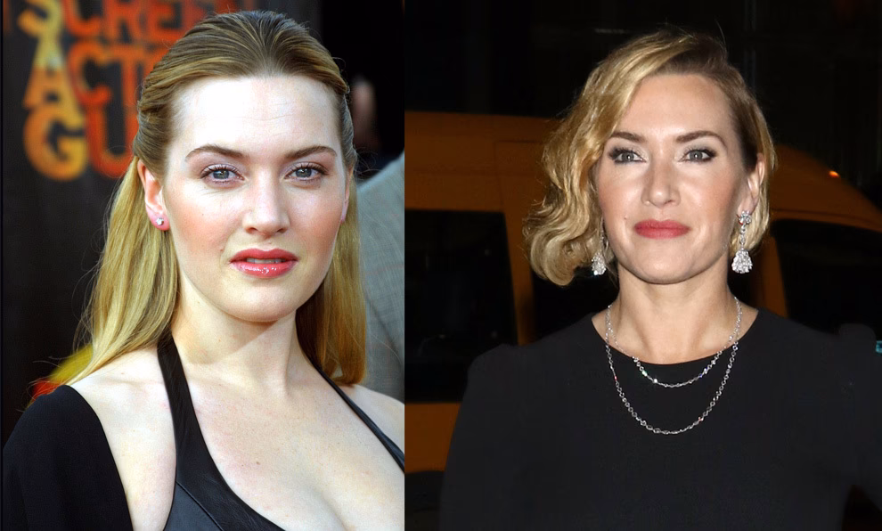 Kate Middleton: ¿Cirugía Real o Rumor Real?