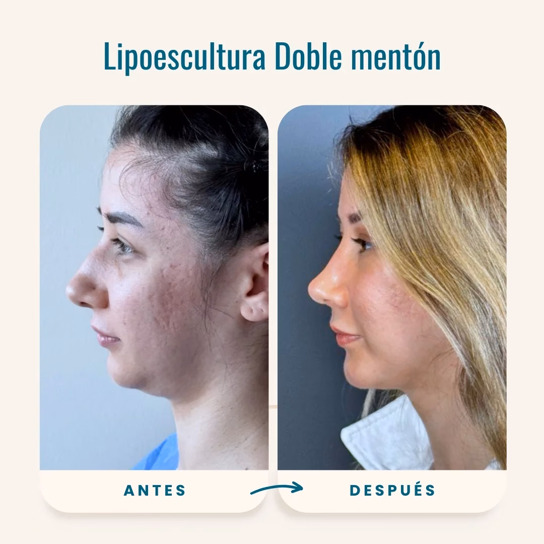 ¿Cómo queda la cara después de una lipopapada?