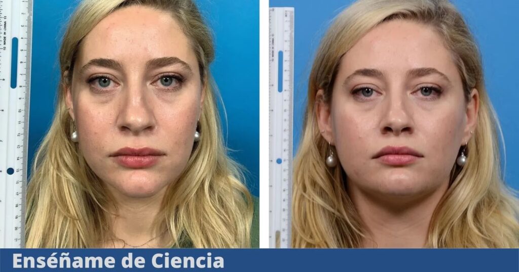 Rinoplastia: La Verdad Tras Selfies y Fibrosis