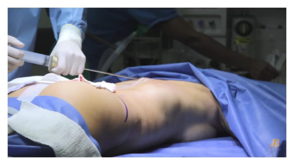 Liposucción: ¿Cuántos Kilos de Grasa se Quitan?