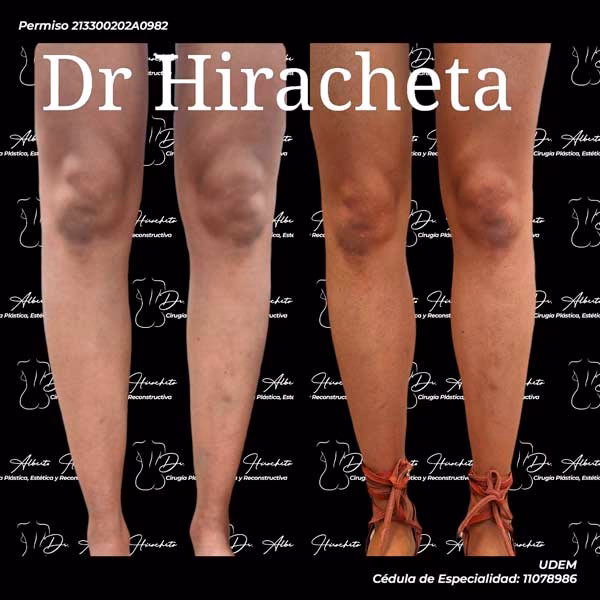 ¿Cuánto cuesta una cirugía de pantorrilla?