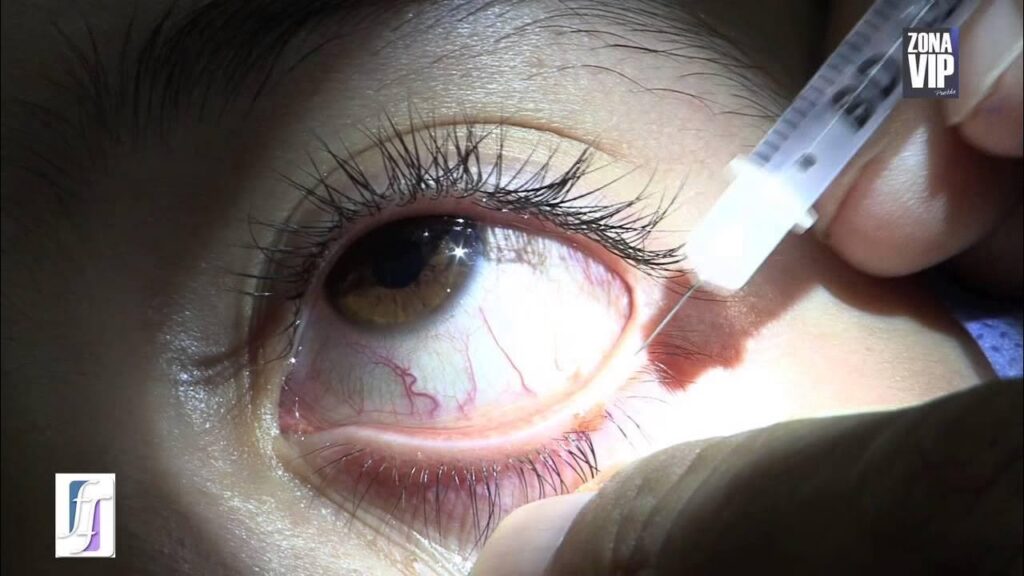 Extirpación de Lunares en Párpados: Guía Completa