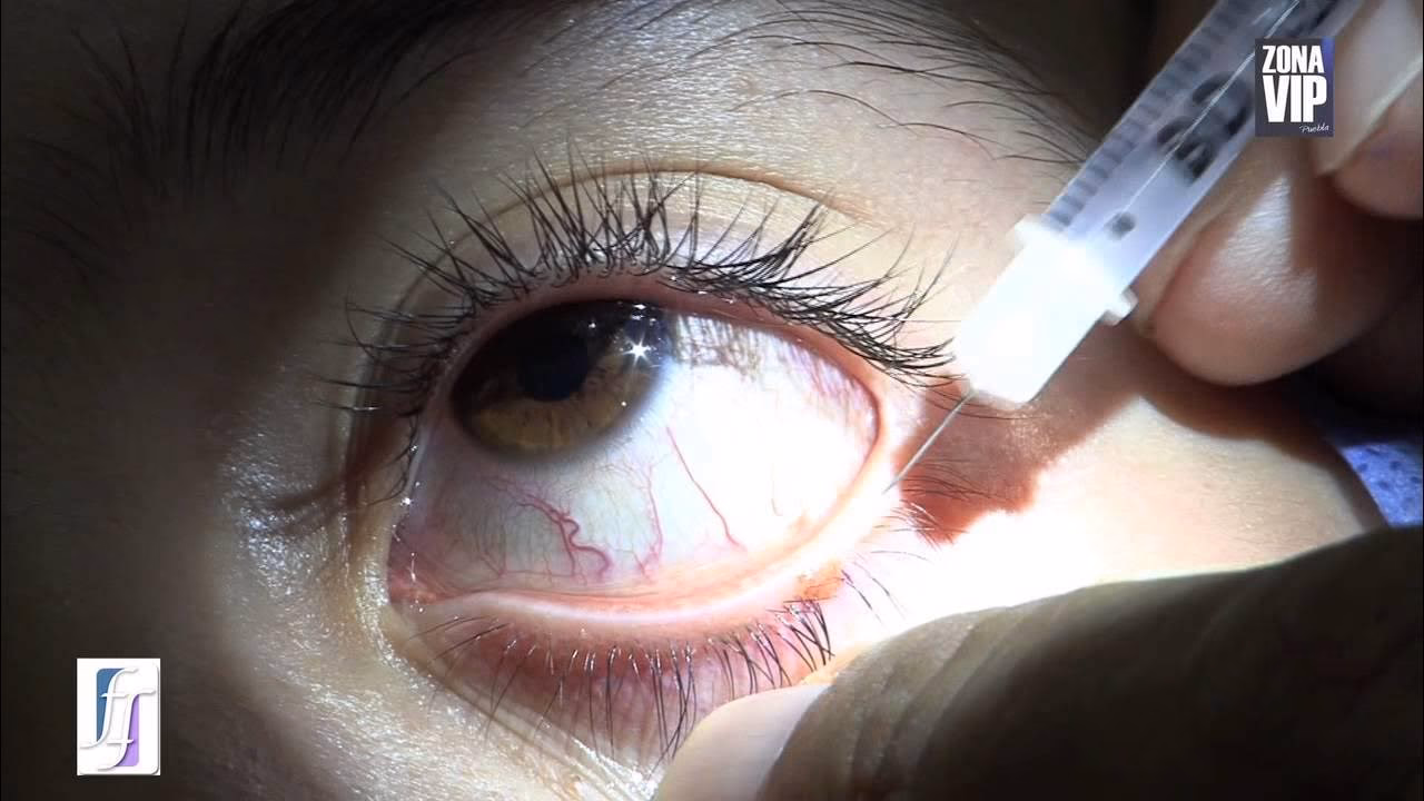 ¿Cuánto cuesta la blefaroplastia superior?