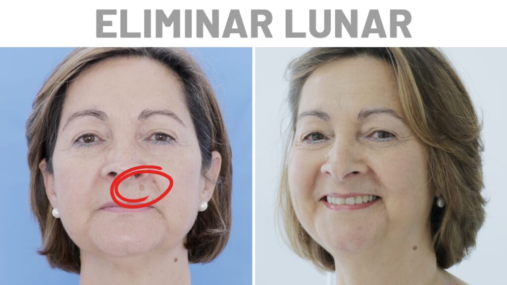 Costo y Proceso para Quitar un Lunar con Cirugía