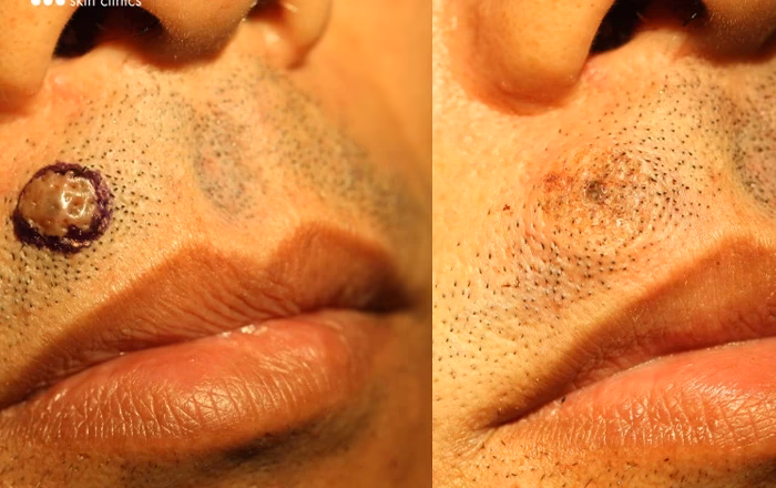 Eliminación de Lunares: Costos, Métodos y Cuidados