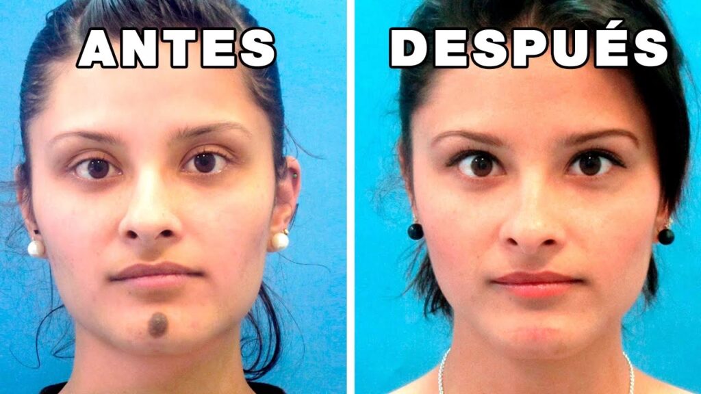 Eliminación de Lunares en la Nariz: Guía Completa