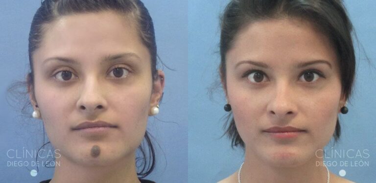 Extirpación de Lunares Faciales: Guía Completa