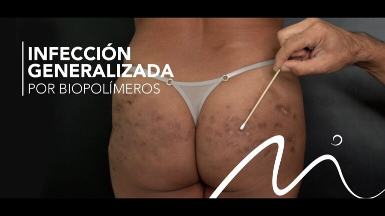 Riesgos del BBL: ¿Puede Infectarse?