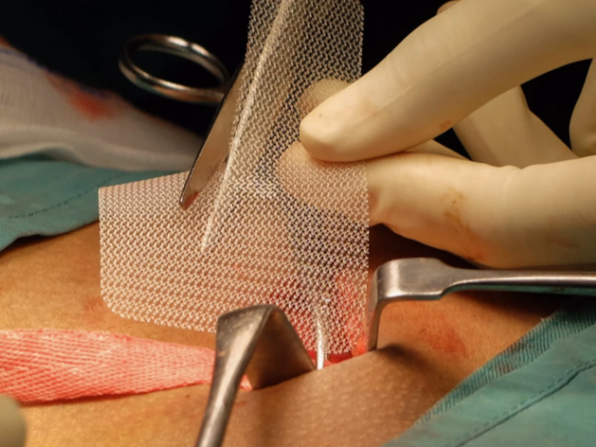 ¿Cuánto tarda en sanar una malla abdominal?