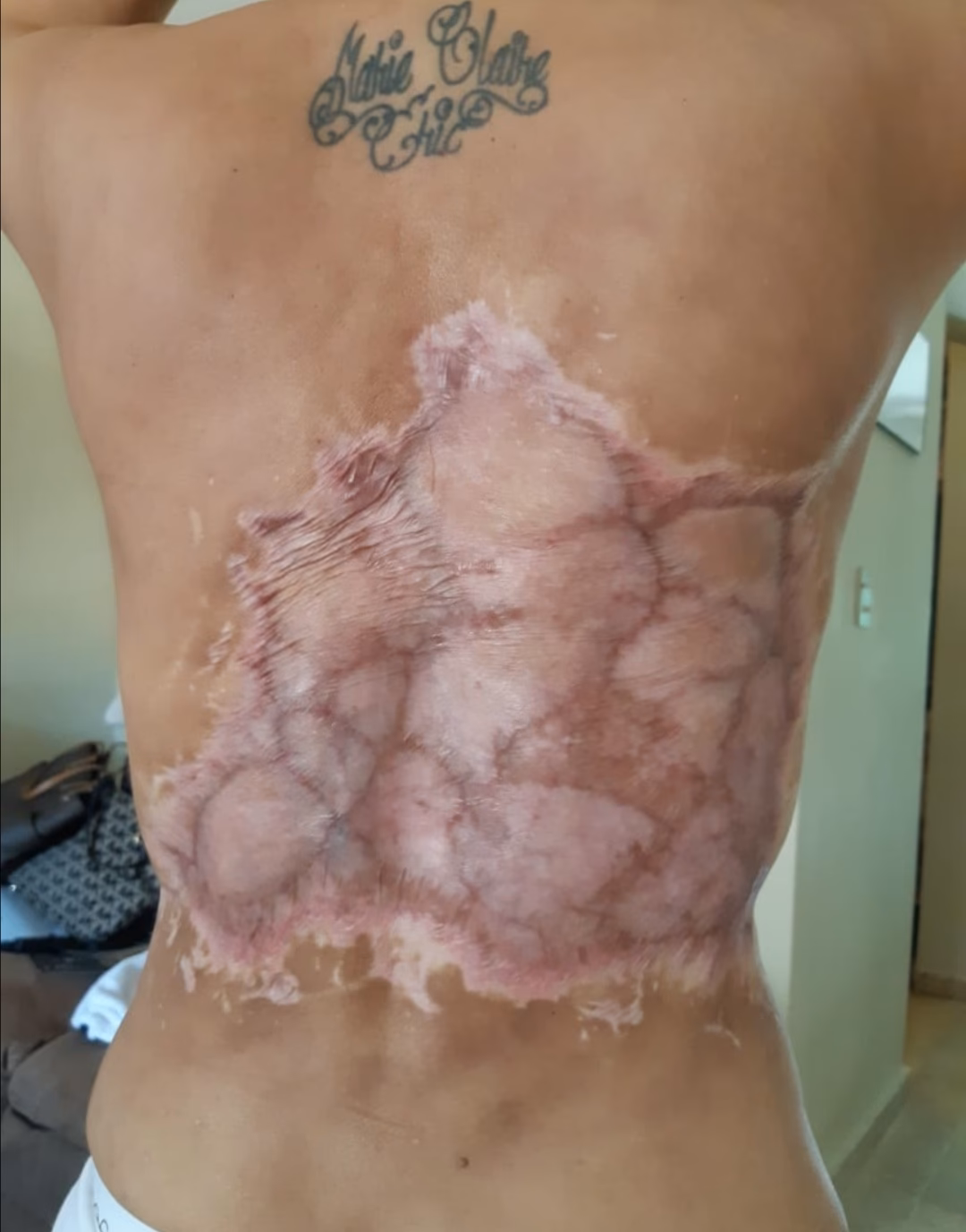 ¿Dónde se operó Maricruz Leiva?