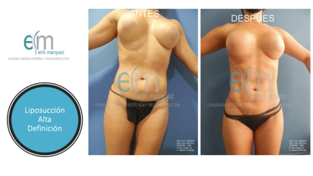 Marc Márquez: Las Cirugías de un Campeón