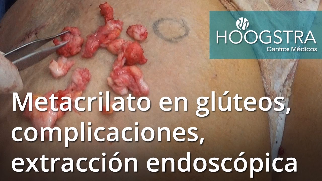 ¿Qué es el metacrilato y para qué sirve?