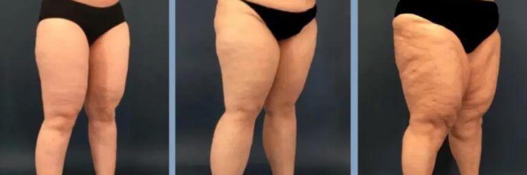 Método Godoy: Revolución en Terapia Linfática