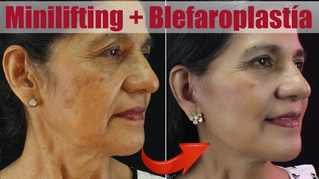 Minilifting Facial: Guía Completa de Rejuvenecimiento