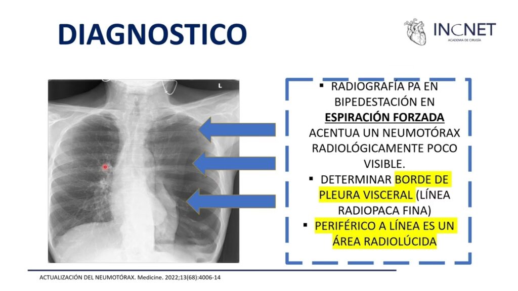Neumotórax y Anestesia: ¿Un Riesgo Real?