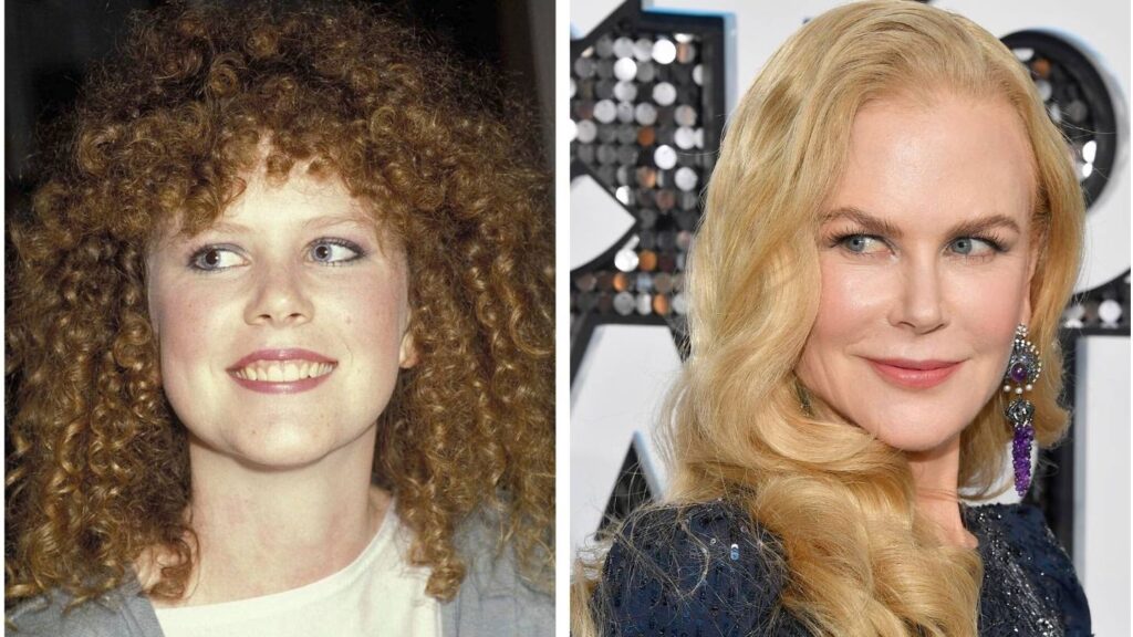 Nicole Kidman: ¿Qué se ha hecho en la cara?