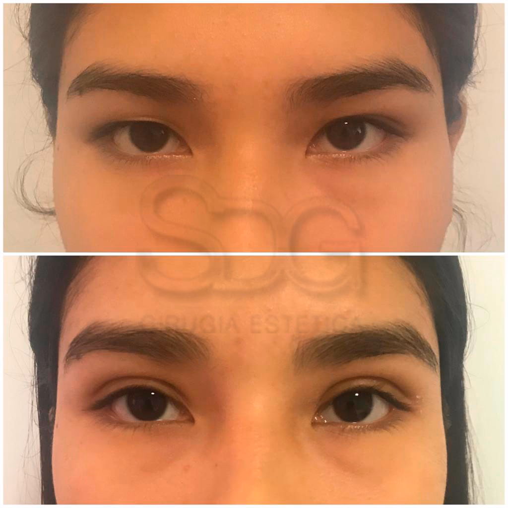 ¿En qué consiste la cirugía palpebral?