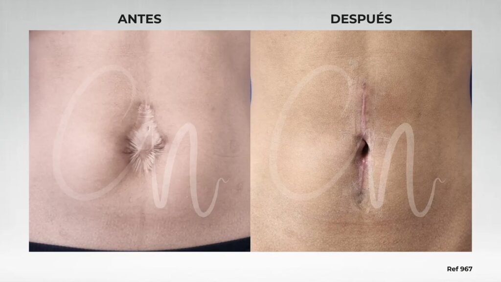Plastia Umbilical: Guía Completa de Recuperación
