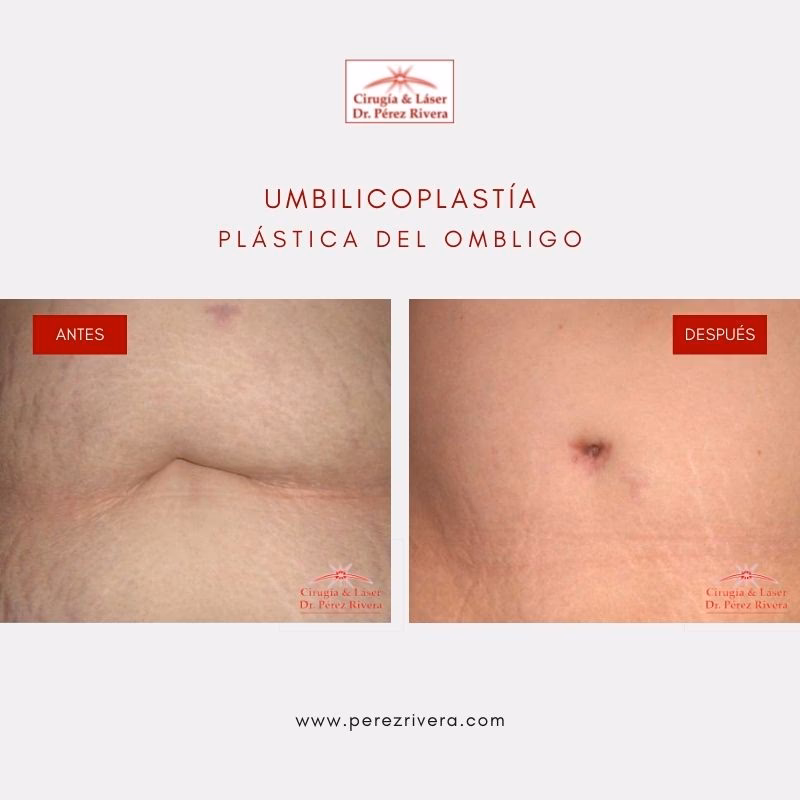 ¿Cuánto cuesta una cirugía estética de ombligo?