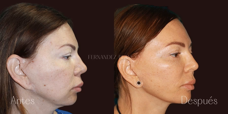 Cirugía de Orejas de Elfo: Costos y Detalles 2024