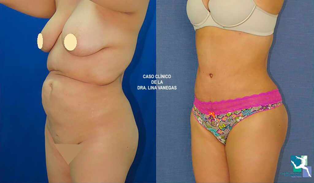 Lipo 360 en Colombia: Guía de Precios y Claves