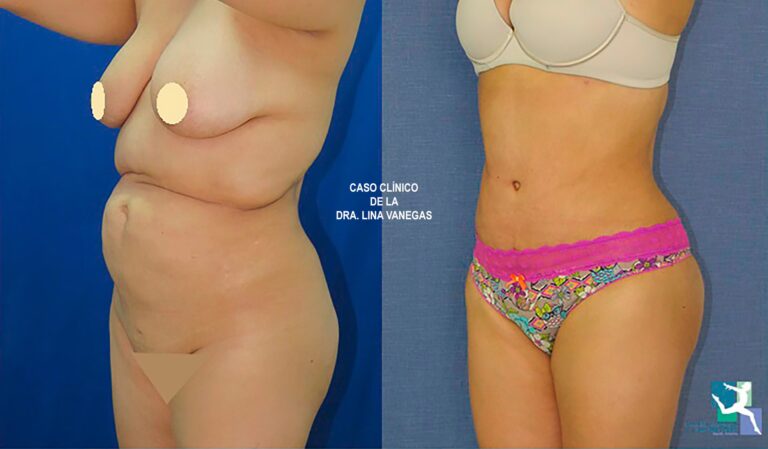 Lipo 360 en Colombia: Guía de Precios y Claves