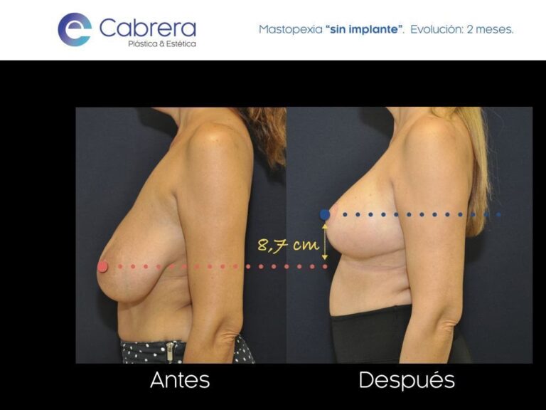 Mastopexia: La Solución a la Flacidez Mamaria
