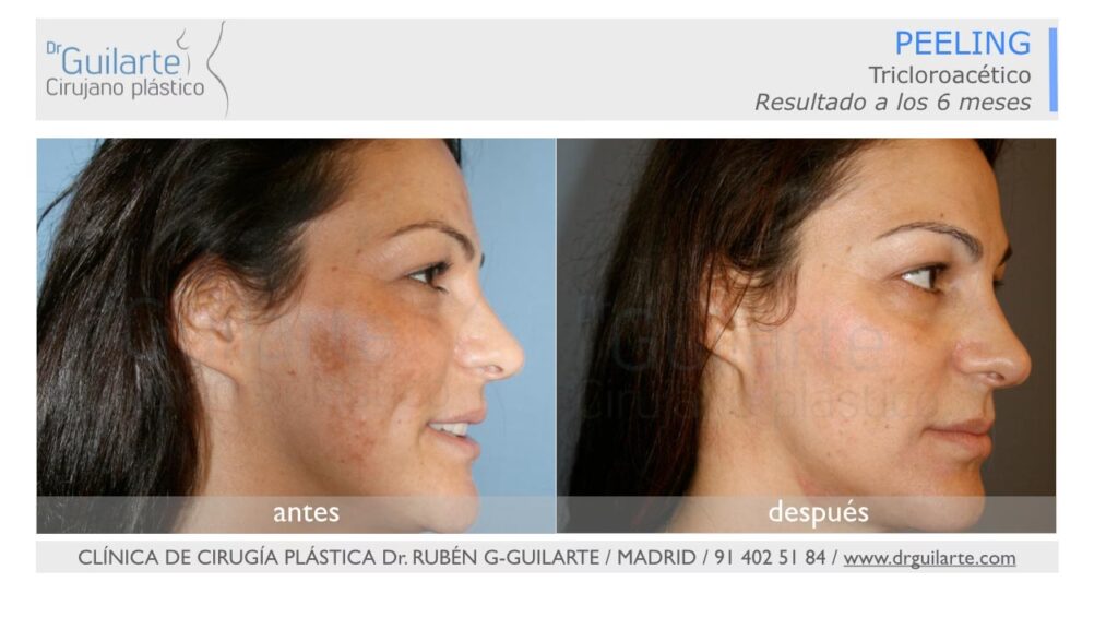 Peeling Químico: Guía Completa de Rejuvenecimiento